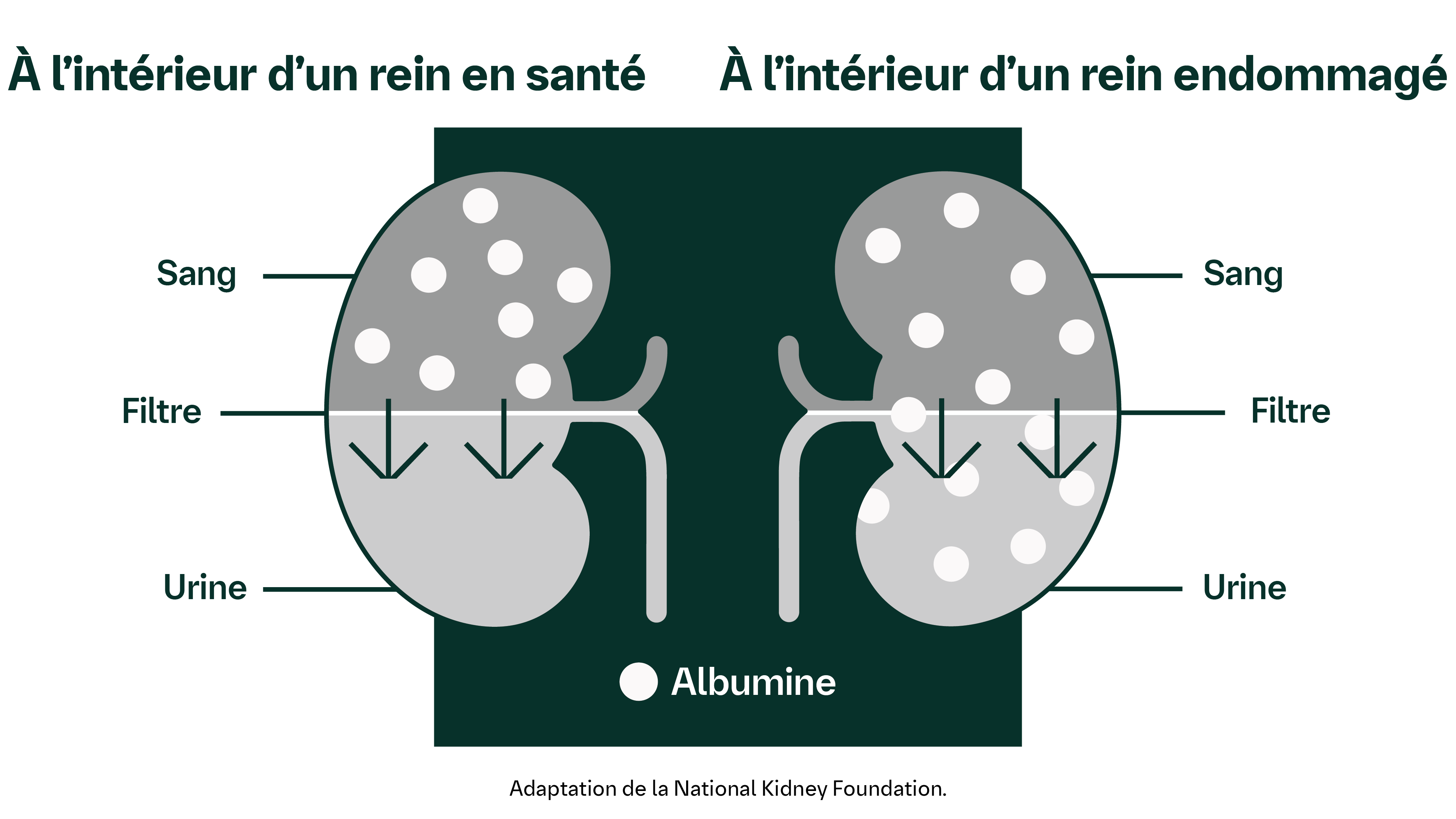 Comparaison d’un rein en santé et d’un rein endommagé. Dans un rein en santé, l'albumine est retenue dans le sang. Le rein endommagé présente une fuite d'albumine dans l'urine.